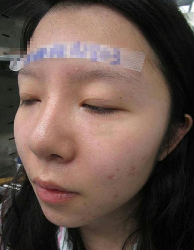 花了13万在郑州安美星河整了全脸唯一后悔的就是(图4)