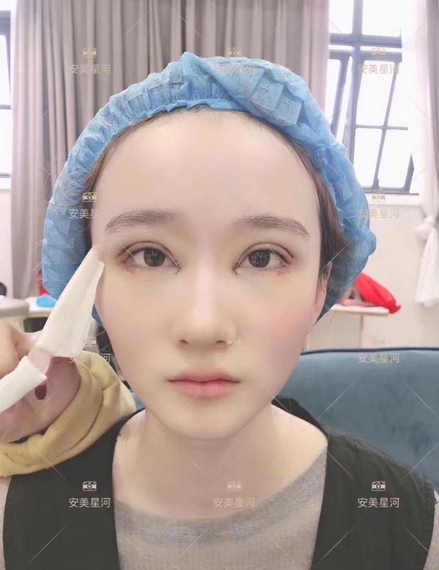 安美星河双眼皮(图2)