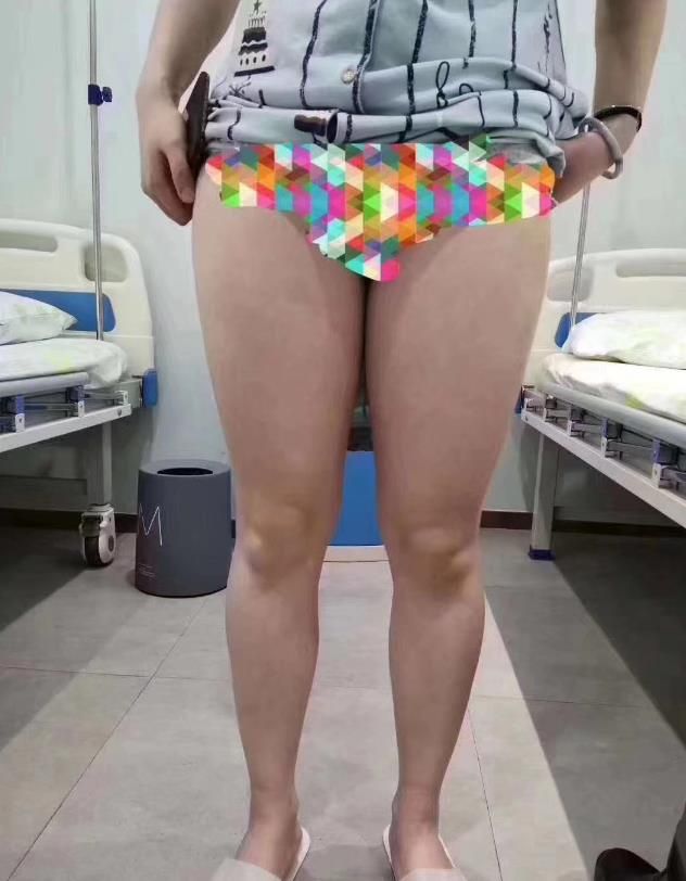 安美星河自体脂肪丰胸  腿部360环吸