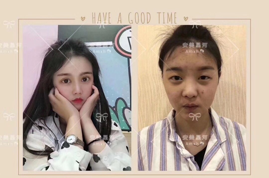 安美星河整形眼综合鼻综合