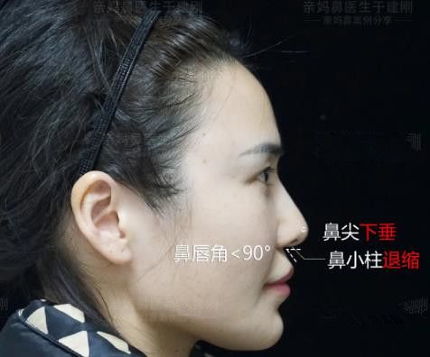 鼻子修复成功成功(图3)