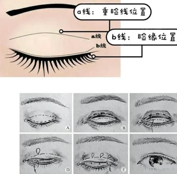 双眼皮修复需要切除疤痕吗？