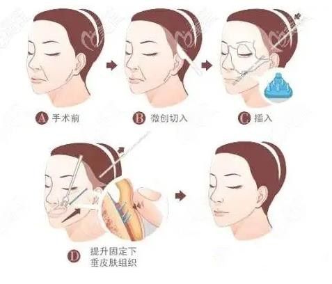 河南郑州整形抗衰之做了“拉皮”才知道4件事？