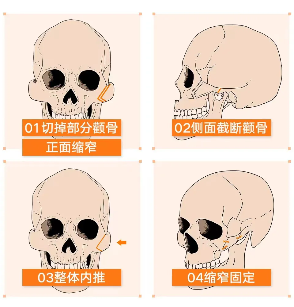 颧弓比较突怎么办