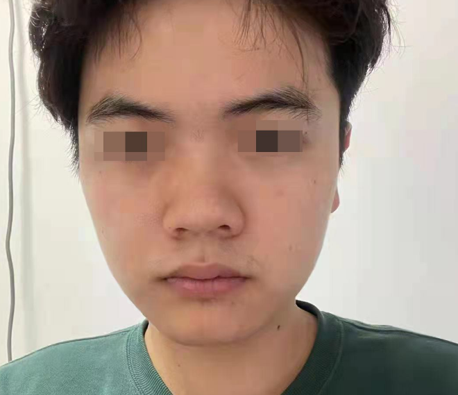 安美星河整形医院男士鼻综合