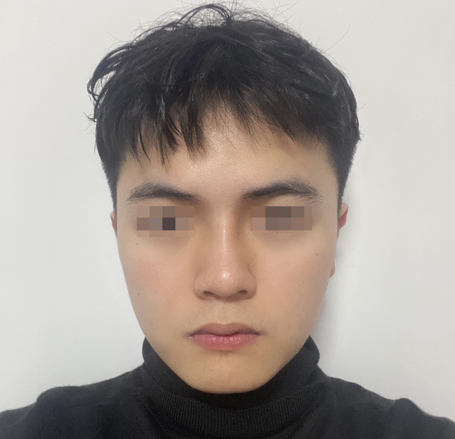 安美星河整形医院男士鼻综合(图2)