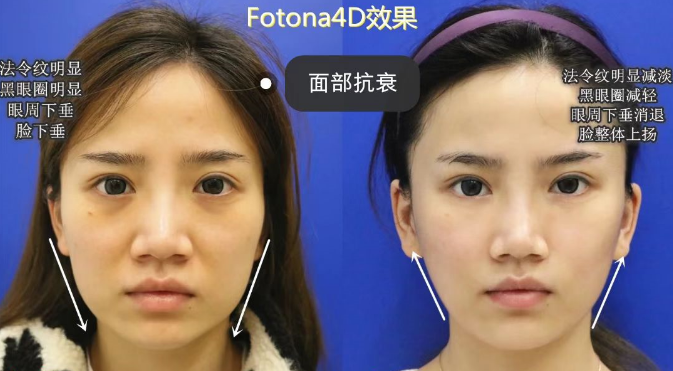 安美星河整形医院提醒30岁以上适合哪些医美项目攻略(图3) 安美星河整形医院提醒30岁以上适合哪些医美项目攻略(图3)
