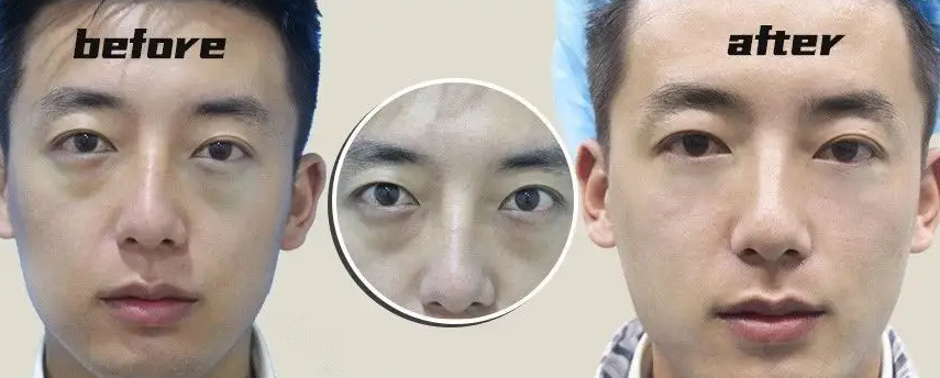 安美星河医疗美容男士眼袋