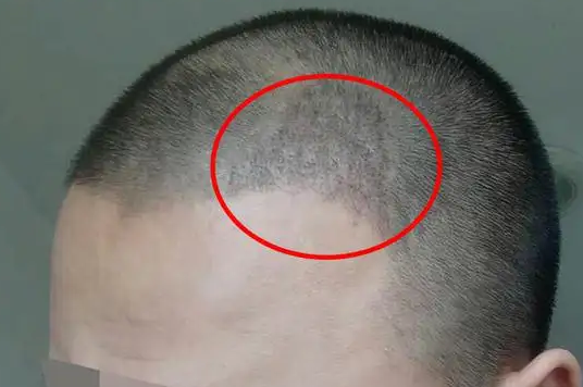 有疤痕可以做植发植眉培训吗
