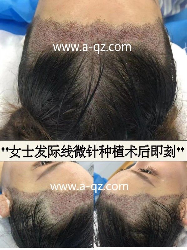 植发大概需要多少钱？植发培训班多少钱？(图2)