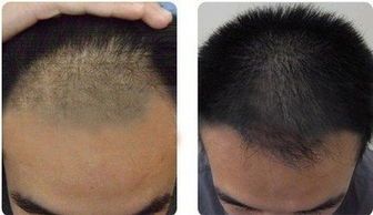 年轻人脱发怎么办，怎么让头发浓密(图2)