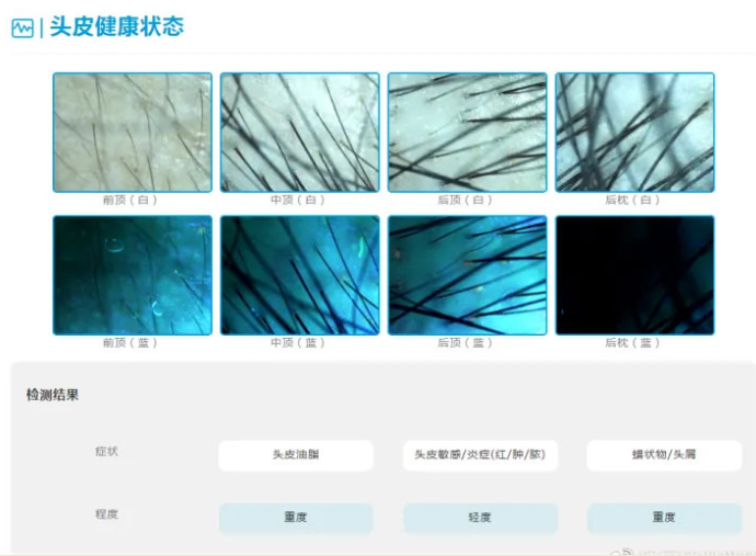 脱发怎么办？治疗脱发前先毛囊检测(图2)