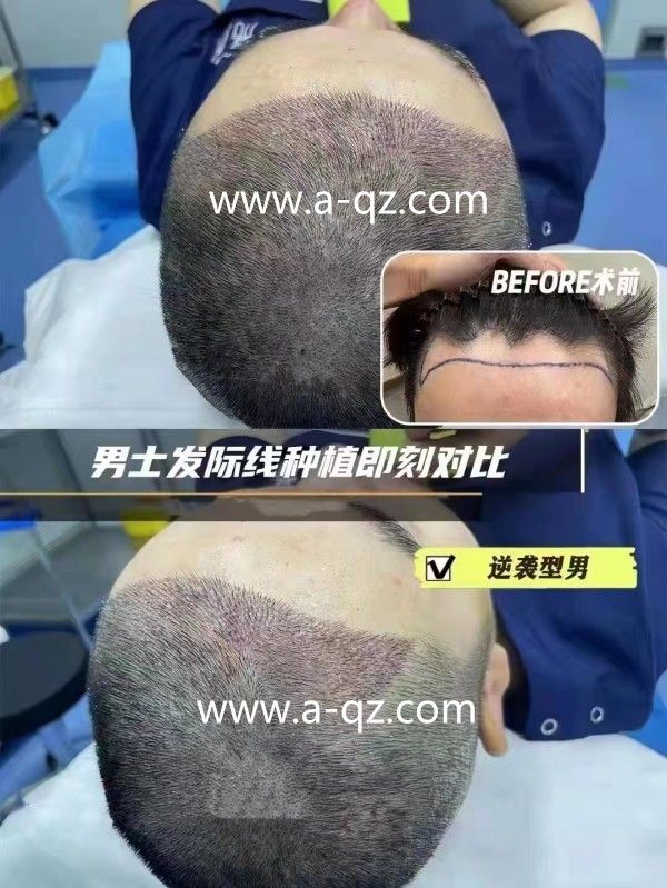 学习植发植眉培训之植发有没什么危害？(图2)